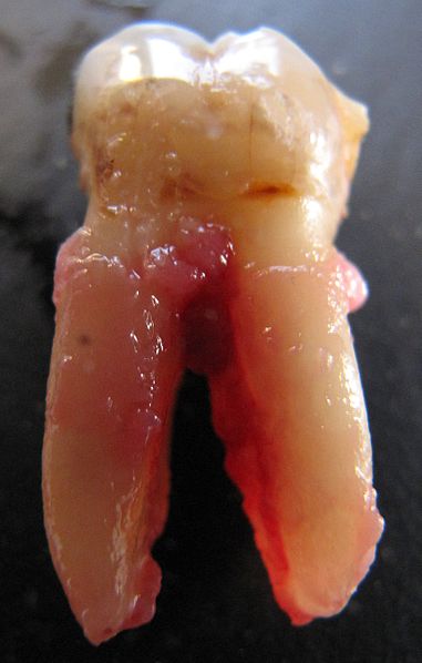 Extracted Tooth