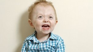 Finley had a singular genetic condition called Apert Syndrome